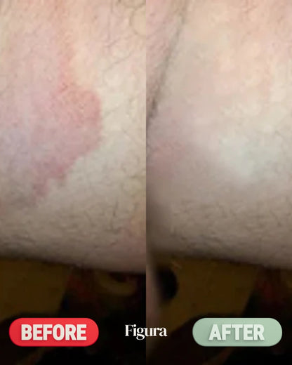 Figura Antifungal Soap Bars