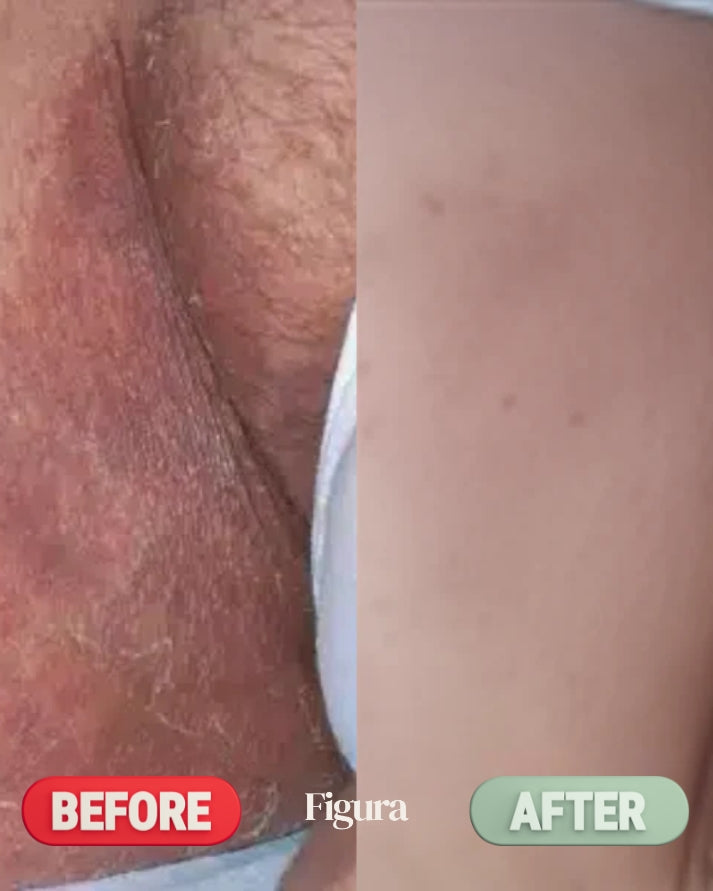 Figura Antifungal Soap Bars