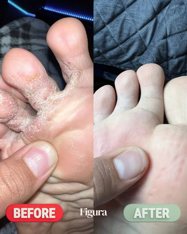 Figura Antifungal Soap Bars