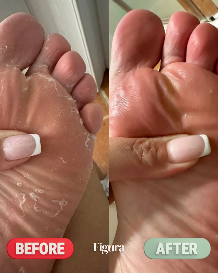 Figura Antifungal Soap Bars