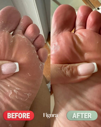 Figura Antifungal Soap Bars